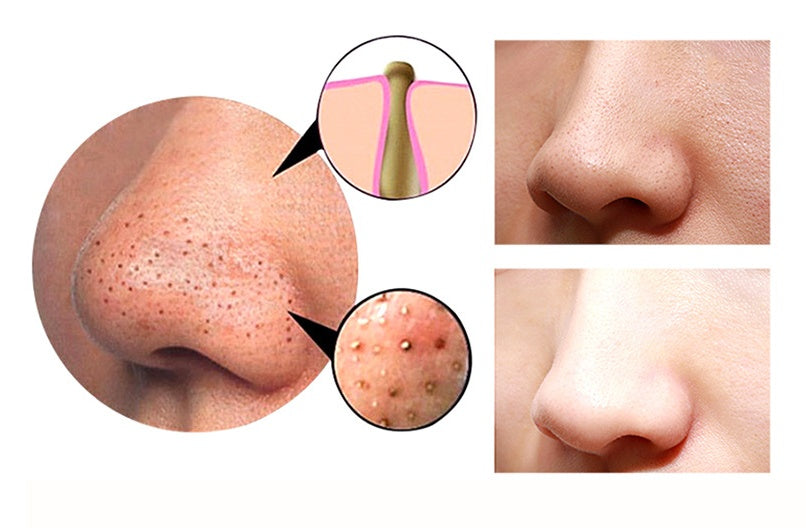4 in 1 Cupping Blackhead Remover Machine Facial Pore Deep Cleansing Beauty Skin Care